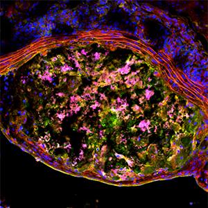 Atherosclerosis Is Alzheimer's Disease of Blood Vessels, Study Suggests