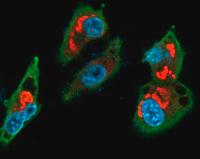 Medulloblastoma 2