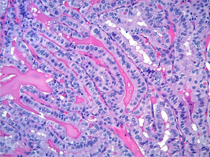 Thyroid Cancer (3 of 3)