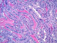 Thyroid Cancer (3 of 3)
