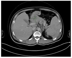 A peculiar case of primary lymphoma of pancreas: A rare presentation of Hodgkin lymphoma
