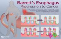 Progression to Cancer