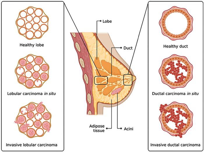 Enhancing breast cancer detection with AI for early diagnosis and recurrence prediction