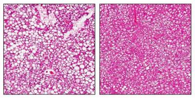 Fat Droplets in Liver Cells