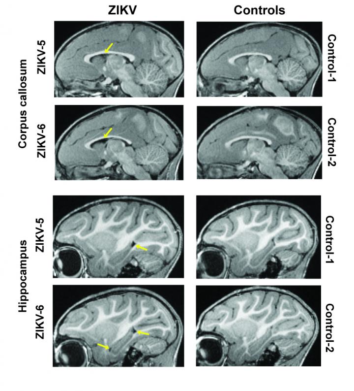Zika Infection Post-Birth Alters Brain Structure and Behavior in Infant Monkeys