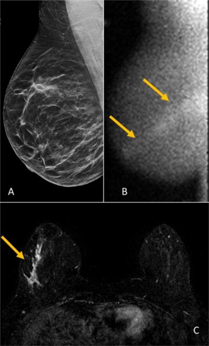 Images in a 48-year-old woman who presented for screening.