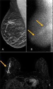 Images in a 48-year-old woman who presented for screening.