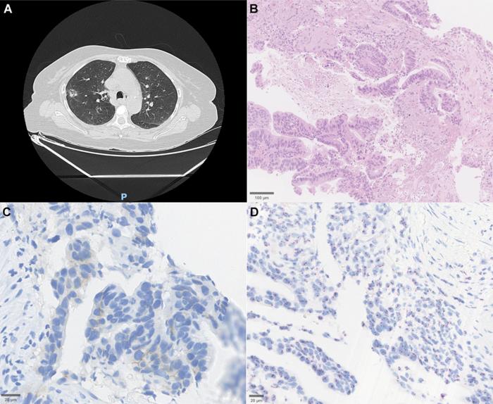 Molecular landscape of HER2-mutated non-small cell lung cancer in Northeastern Brazil: Clinical, histopathological, and genomic insights