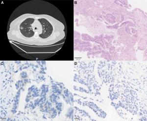 Molecular landscape of HER2-mutated non-small cell lung cancer in Northeastern Brazil: Clinical, histopathological, and genomic insights