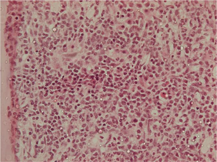 EZH2 Delays the Development of Leukemia