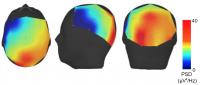 Brain Region Affected by Essential Tremor
