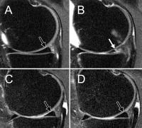 Weight Loss Through Exercise Alone Does Not Protect Knees (3 of 3)