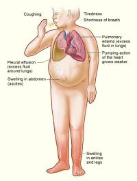 Heart Failure Symptoms