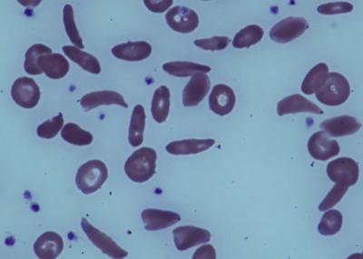 Blood Pre-transplant