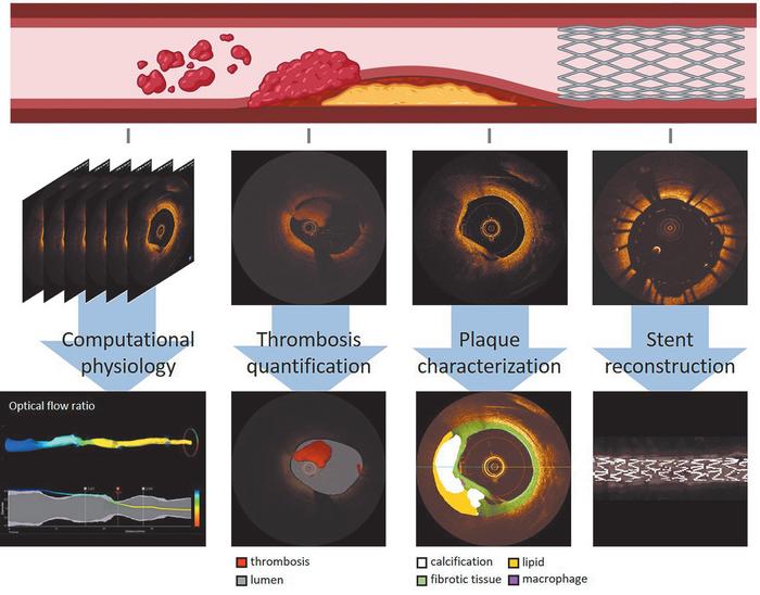 Figure 4Open multimedia modalSchematic of artificial intelligence-driven computational methods in intravascular imaging.