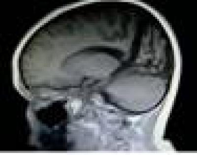Postoperative MRI