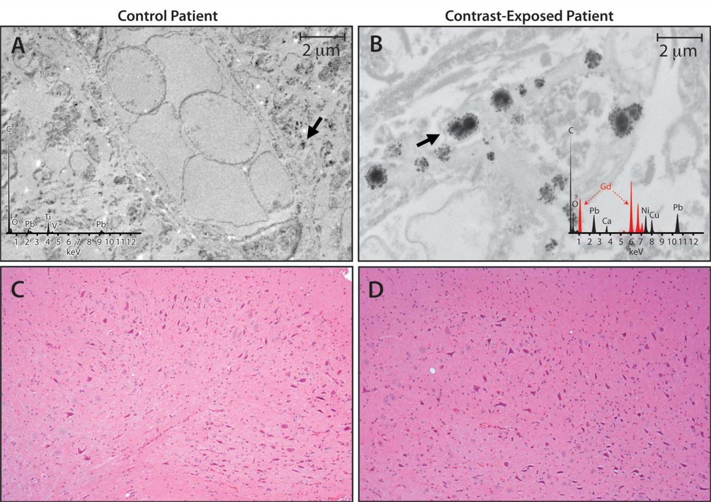 Study Finds No Evidence that Gadolinium Causes Neurologic Harm (2 of 3)