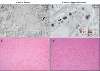 Study Finds No Evidence that Gadolinium Causes Neurologic Harm (2 of 3)