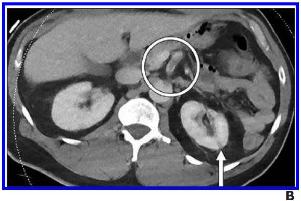 Patients With Arterial Thromboembolism Associated With COVID-19