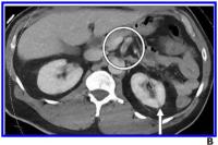 Patients With Arterial Thromboembolism Associated With COVID-19