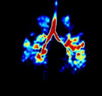 Emphysema Lung