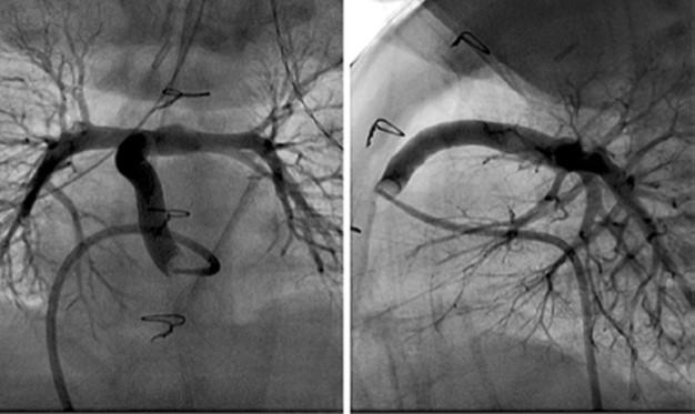 A Reinforced Cylinder Leads to Fewer Repeat Surgeries for Children Born with Heart Defect