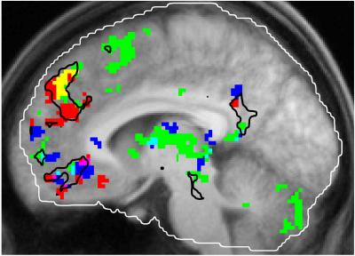 Study Finds Brain Hub That Links Music, Memory and Emotion