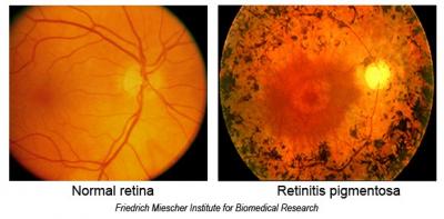 Retinas