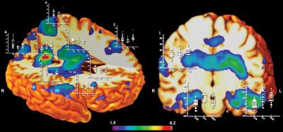 Prenatal Meth vs. Alcohol Brain Volume