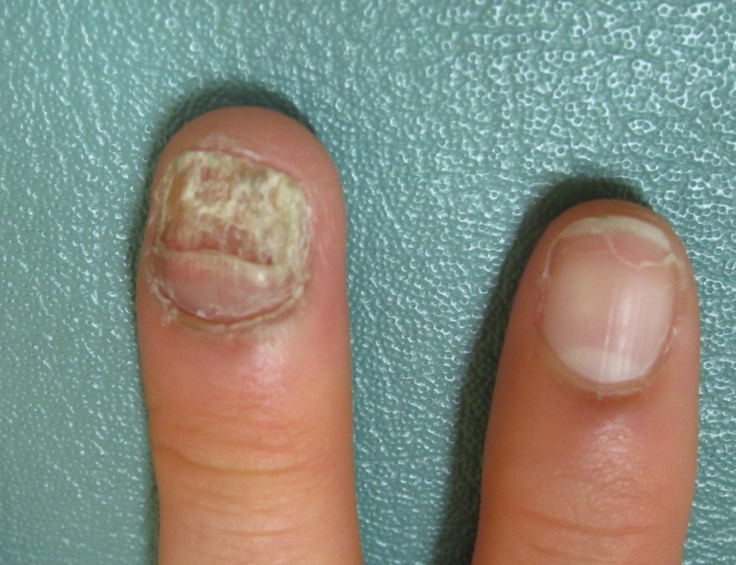 GOF STAT1 Phenotype