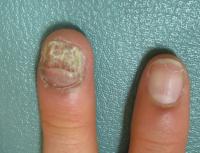 GOF STAT1 Phenotype