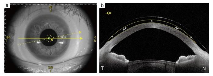 SS-OCT imaging and analysis of fluid reservoir boundaries.