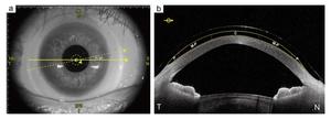 SS-OCT imaging and analysis of fluid reservoir boundaries.