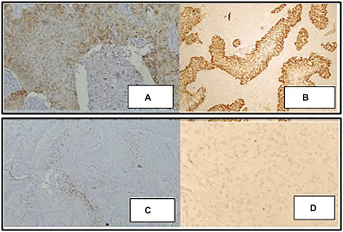 MRI in deciphering the superficial spread of cervical squamous cell carcinoma into the uterine corpus: A case report and literature review