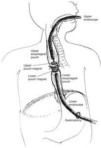 Fig. 1. Method of magnet placement.
