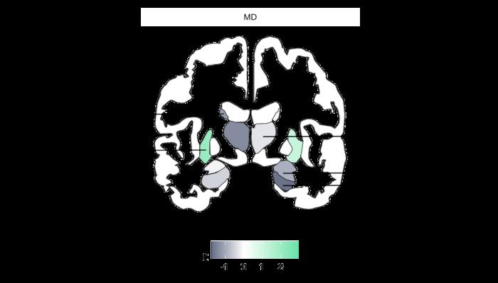 Brain regions associated with high consumption of ultra-processed foods