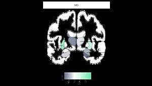 Brain regions associated with high consumption of ultra-processed foods