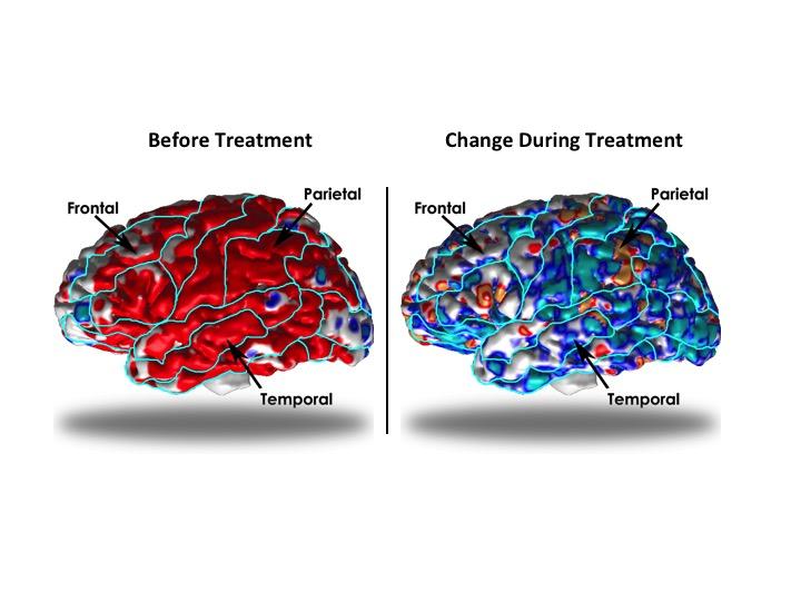 Brain Scans of Chronically Depressed Patients Before and During Treatment