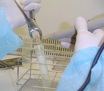 Ancient Genetic Material from Caries Bacterium Obtained for the First Time