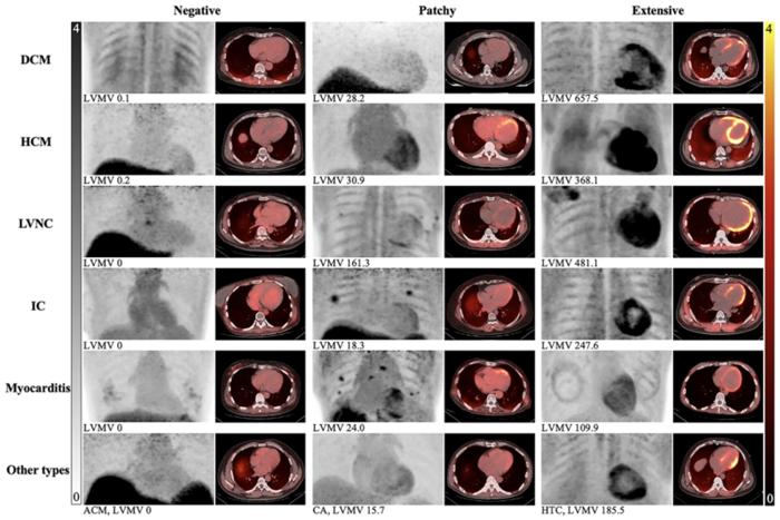 Maximum-intensity projections and fusion images of [68Ga]Ga-FAPI PET/CT from representative patients of different NICM subtypes.
