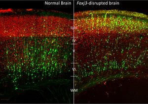 Genetic and pedigree analysis of a family with focal cortical epilepsy and focal1317 cortical dysplasia associated with a novel FOXJ3 variant