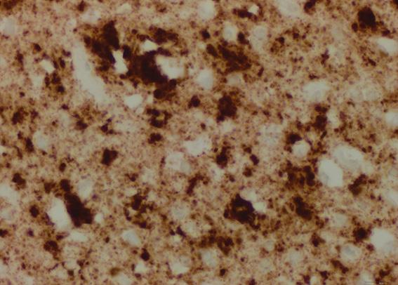 Brain of sCJD Patient