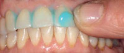Rub Your Teeth After Lunch