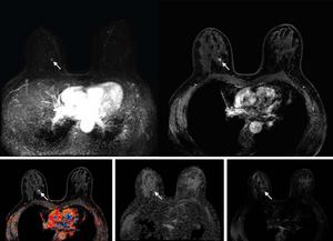 Abbreviated breast MRI images