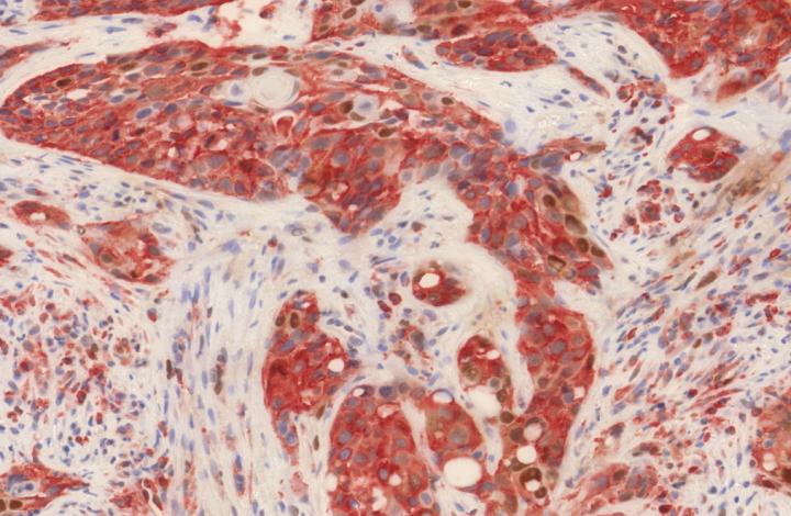Section of a Head and Neck Cancer Biopsy