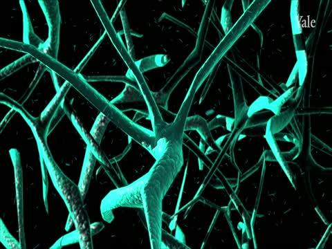 Yale-Developed Test for Alzheimer's Disease