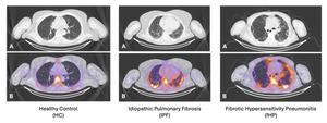 New SPECT Imaging Approach Distinguishes Inflammation from Fibrosis to Optimize Treatment for Lung Disease