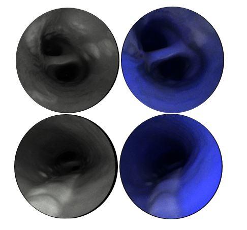 Laser-Based Camera Improves View of the Carotid Artery