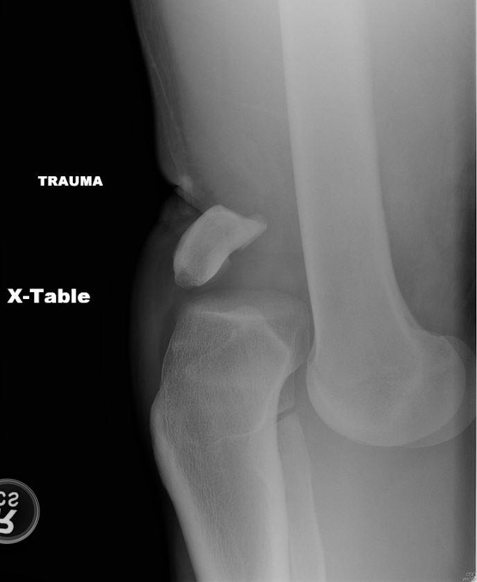 Severe Dislocation