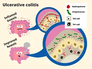 How smoking reduceds inflammation in ulcerative colitis